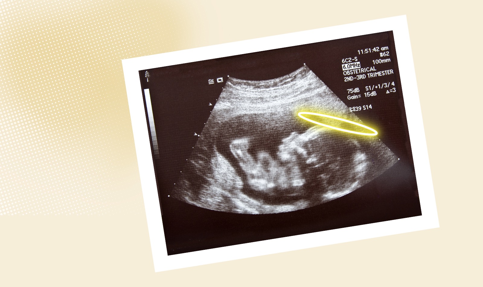 Ultraschallbild eines ungeborenen Babys im Mutterleib mit Heiligenschein über dem Kopf