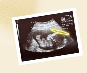 Ultraschallbild eines ungeborenen Babys im Mutterleib mit Heiligenschein über dem Kopf